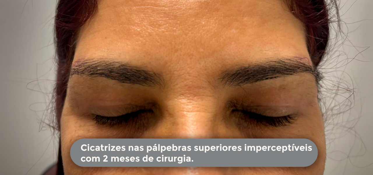 Cirurgia da Pálpebra - resultado