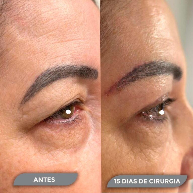 Cirurgia de Pálpebra - antes e depois com 15 dias