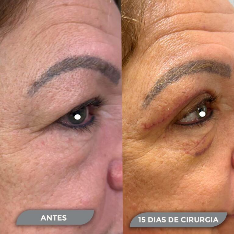 Cirurgia de Pálpebra - resultado antes e depois com 15 dias