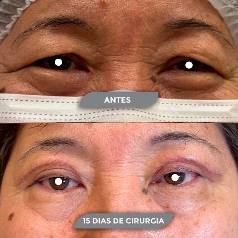 Cirurgia de Pálpebra - resultado com Dra. Andreise Paro